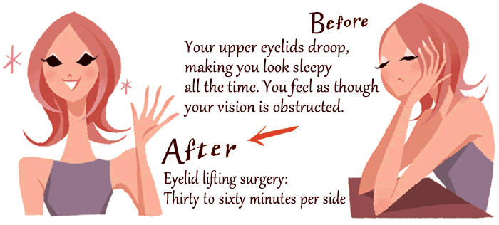 [Before] Your upper eyelids droop, making you look sleepy all the time. You feel as though your vision is obstructed. [After] Eyelid lifting surgery: Thirty to sixty minutes per side