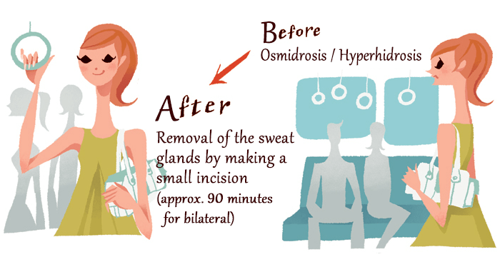 [Before] Osmidrosis / Hyperhidrosis [After] Removal of the sweat glands by making a small incision (approx. 90 minutes for bilateral)