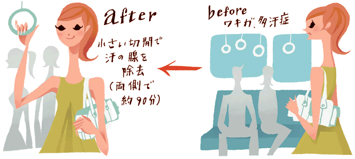 【before】ワキガ、多汗症→【after】小さい切開で汗の腺を除去(両側で約90分)